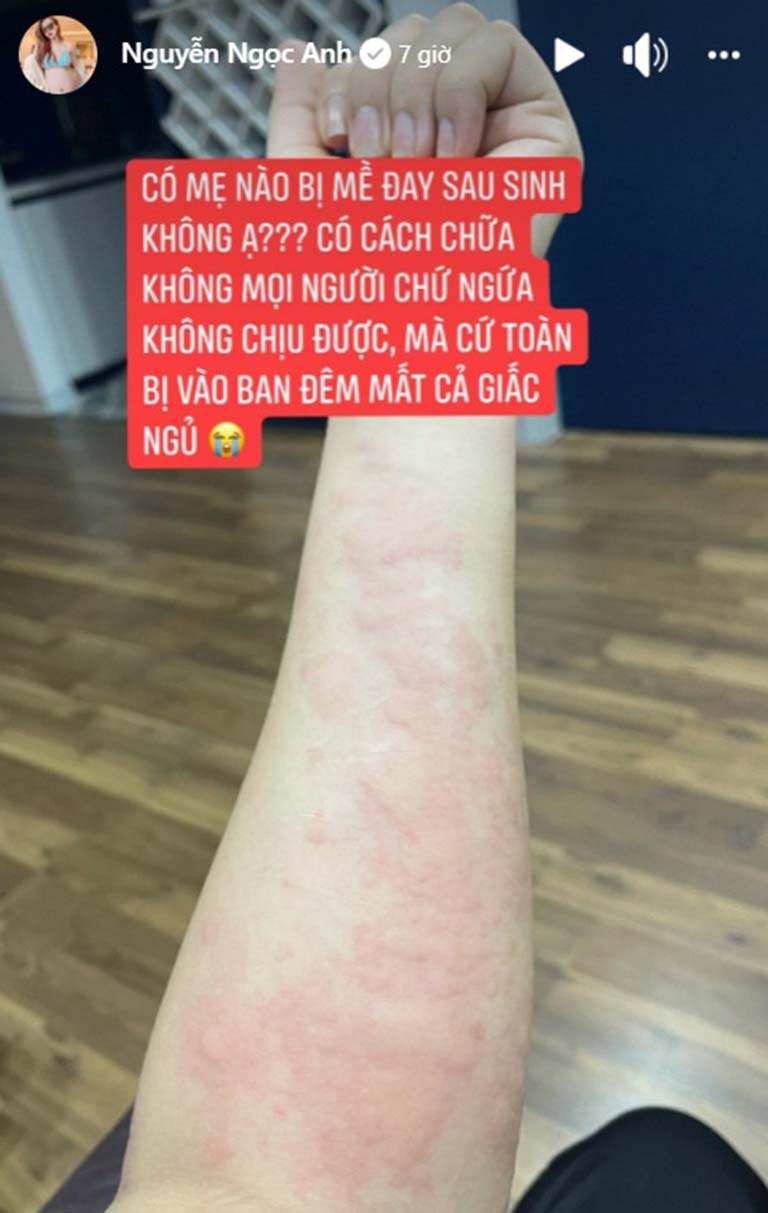 nổi mề đay trên da sau sinh