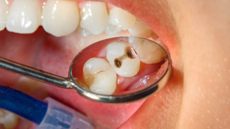 răng hư dẫn đến tình trạng viêm xoang hàm
